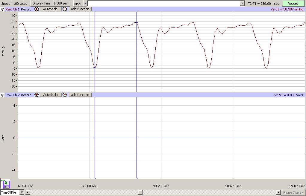 Low Flow Dampening Kit for a Pump